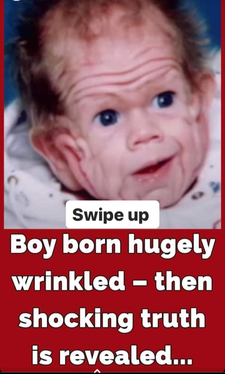 Tomm Tennent: The unique baby born with enough skin to cover the body of a five-year-old child