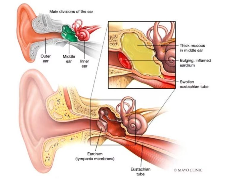 Ear infection (middle ear)