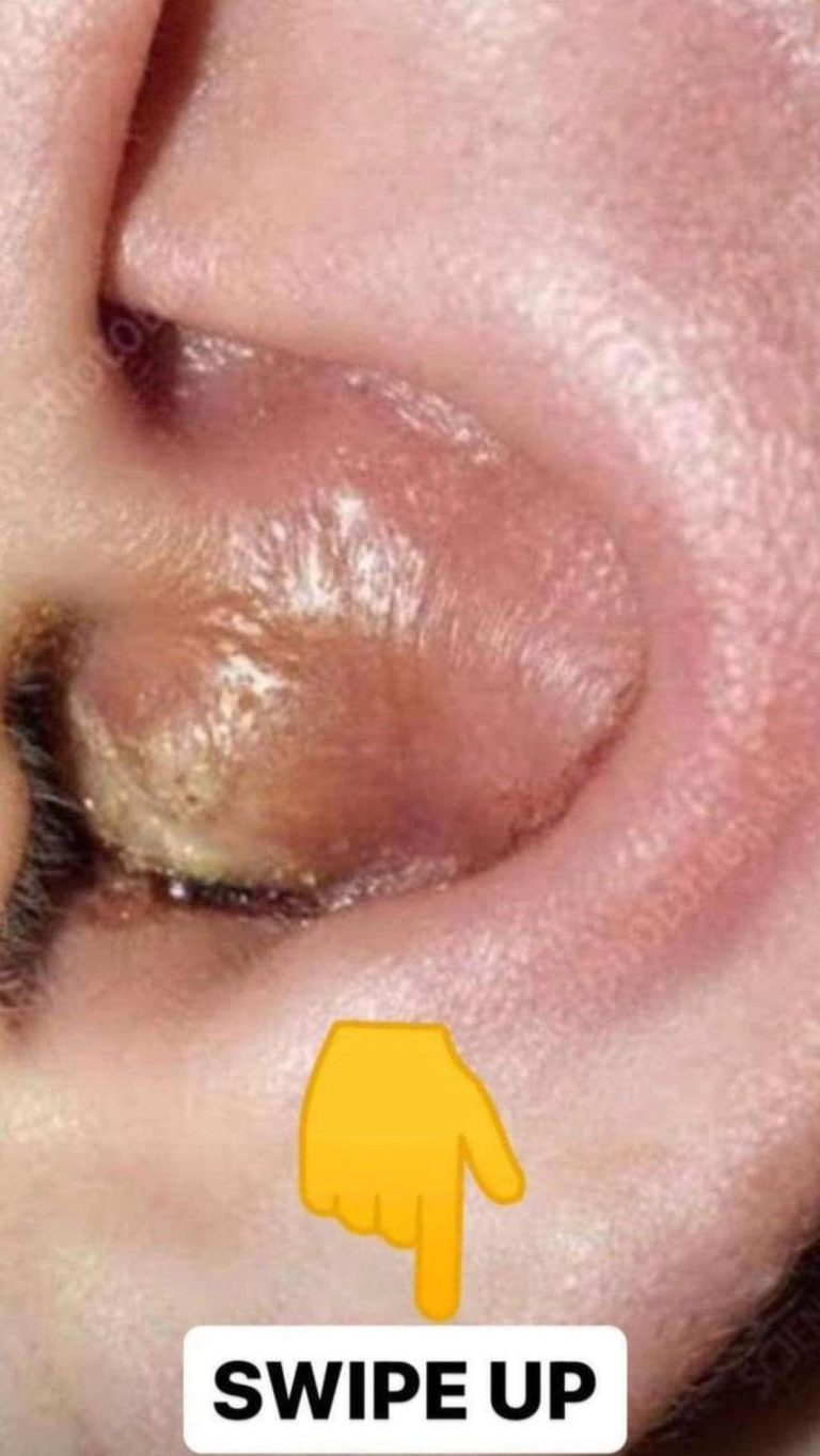 Ear infection (middle ear)