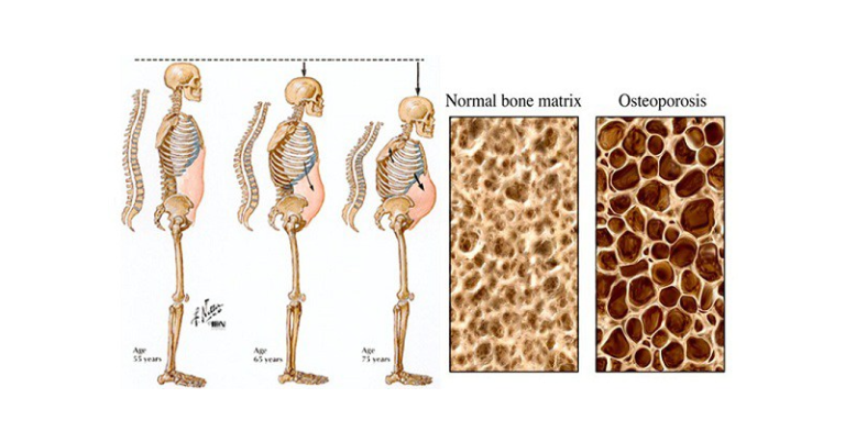 This drink will destroy your bones from the inside but millions of people consume it every day