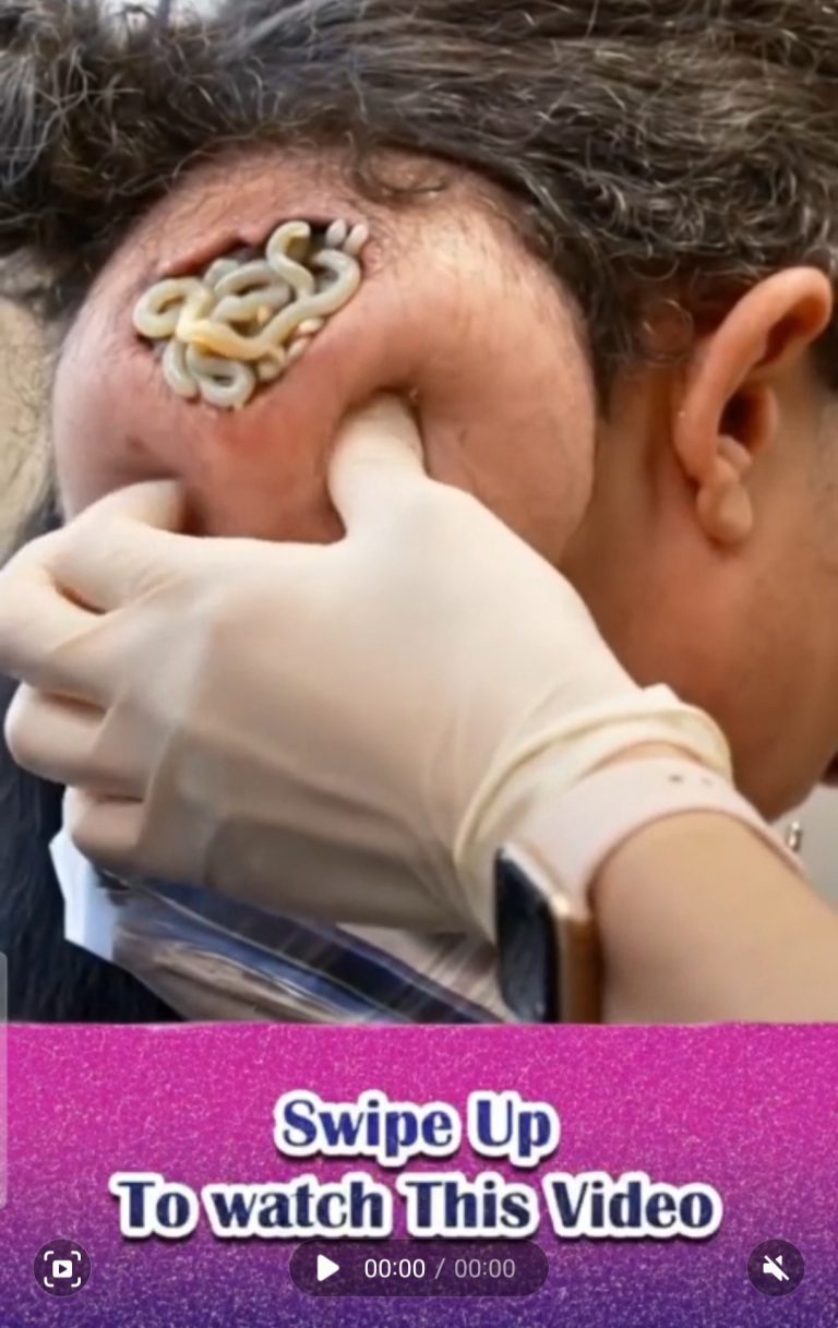 Dr Ryan Removes Painful And Bleeding Neck Tumour