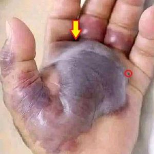 Black hand shows dangerous of untreated infection…