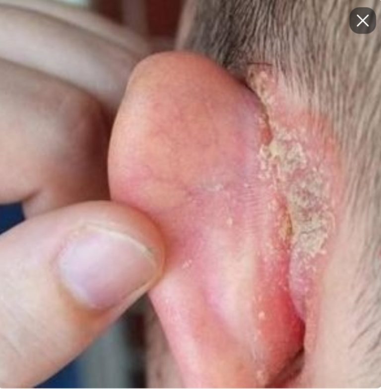I noticed a strange patch of skin on my son’s ear this morning. His doctor appointment is still a week away — what should I do in the meantime?