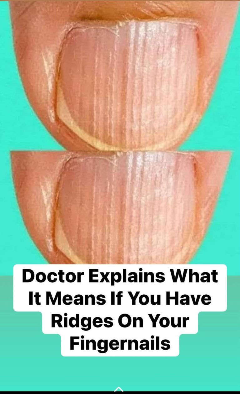 Doctor Explains What It Means If You Have Ridges On Your Fingernails