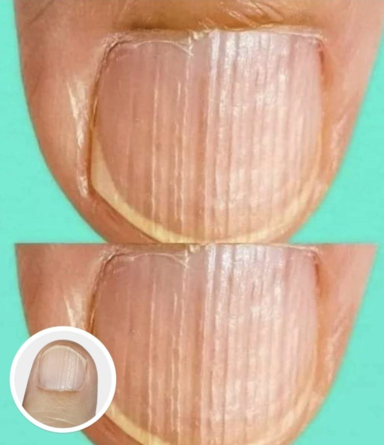Doctor Explains What It Means If You Have Ridges On Your Fingernails