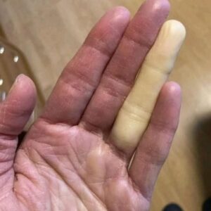 ⚠️ “Why Did My Finger Turn White?” — This Strange Reaction Is More Common Than You Think