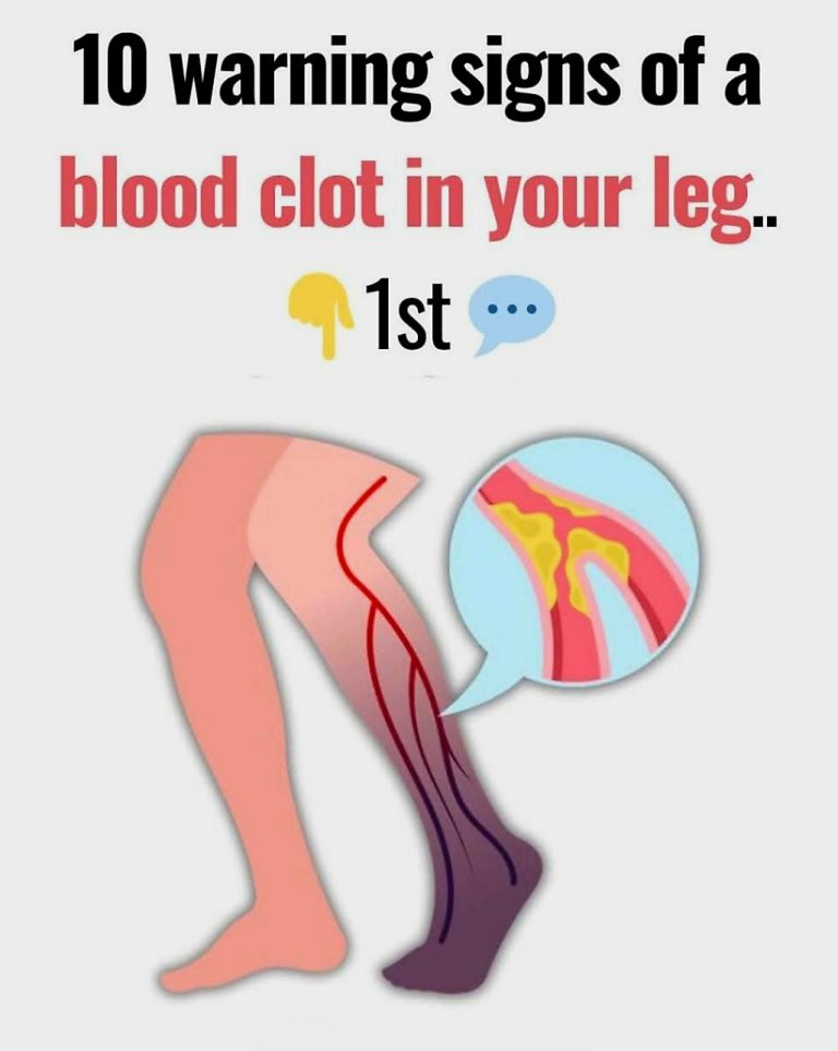 These 10 Silent Signs Could Mean a Dangerous Blood Clot in Your Leg… ⚠️