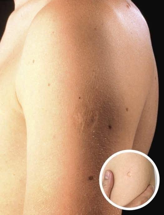 Here’s The Truth Behind This Scar On People’s Upper Left Arm