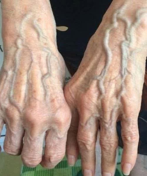😳 Why Are the Veins in Your Hands Looking More Prominent Than Before?