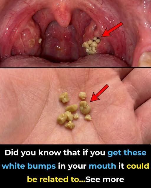 😳 Tonsil Stones: The Strange Problem Many People Don’t Realize They Have Small, white, foul-smelling lumps hidden in the tonsils may seem harmless at first — but for many people, they can become an annoying and recurring problem linked to bad breath, throat discomfort, and irritation. 👇👇