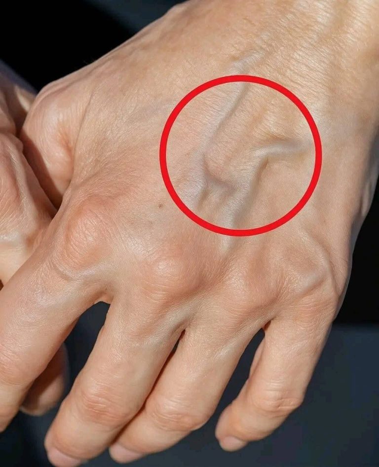 Visible Veins: The Real Reasons and Consequences for Your Health…Have you started noticing your veins becoming more visible or bulged like this lately? 🔍 Most people think it’s just a normal sign of getting older or lifting heavy weights, but doctors reveal there is a much deeper reason behind it. What your hands are actually trying to tell you about your circulation… 😱👇